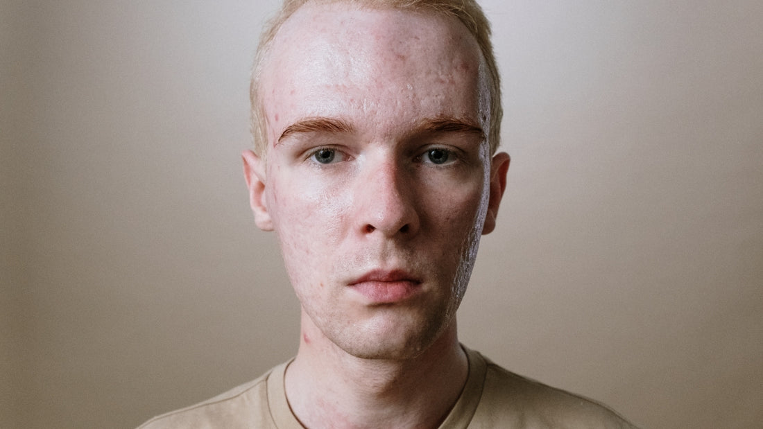 How to Get Rid of Acne Scars? ProFacialWand