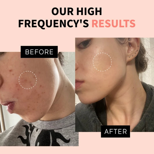 profacialwand high frequency wand before and after