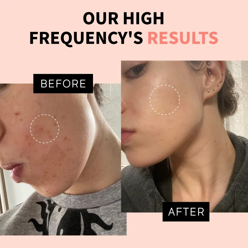 profacialwand high frequency wand before and after