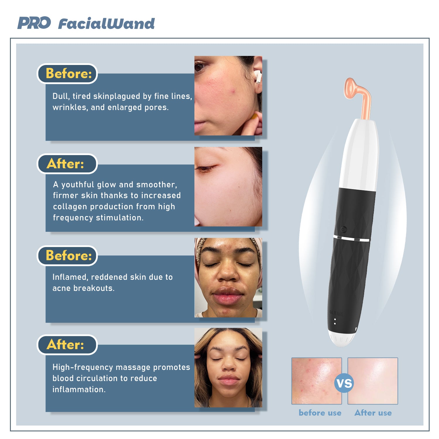 PRO facialwand high frequency facial wand before and after