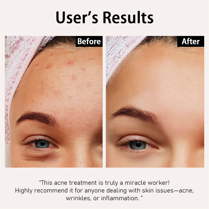 Cordless 3in1 High Frequency Wand - OxyGlow 1 - Neon Gas – Lucsuer